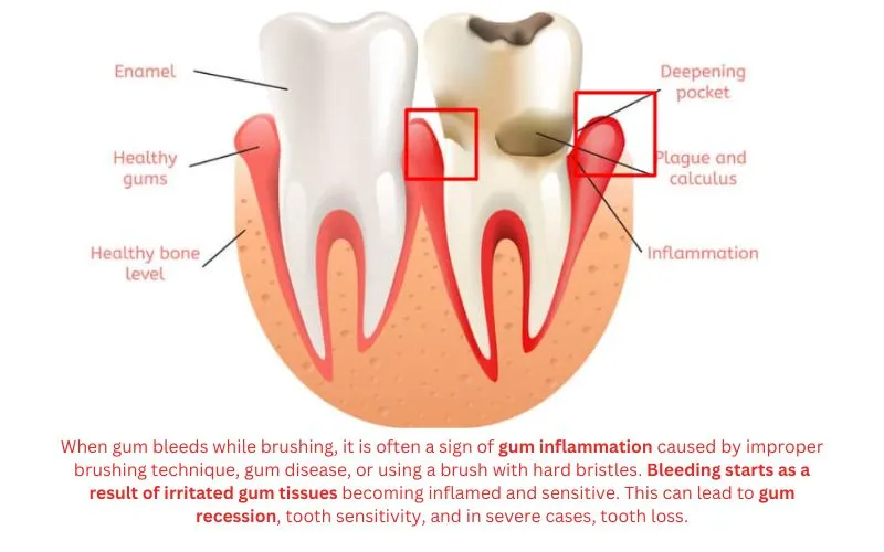 gum-bleeding-while-teeth-brushing