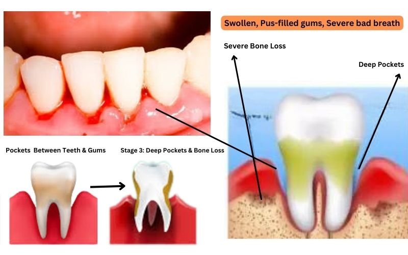 Stage-3-of-gingivitis