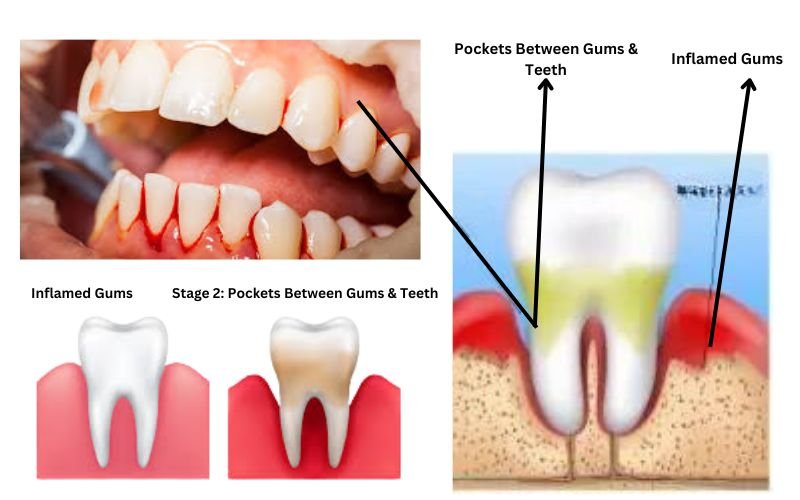 Stage-2-of-gingivitis