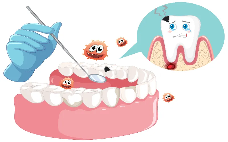 wisdom-teeth-cavities