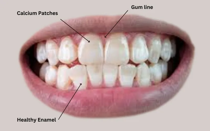 Calcium-Patches-on-teeth
