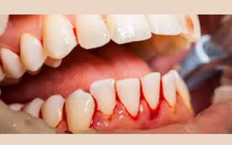 bleeding-gums-while-brushing-teeth