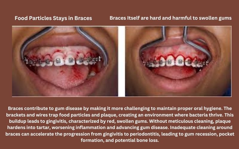 Braces-and-gingivitis