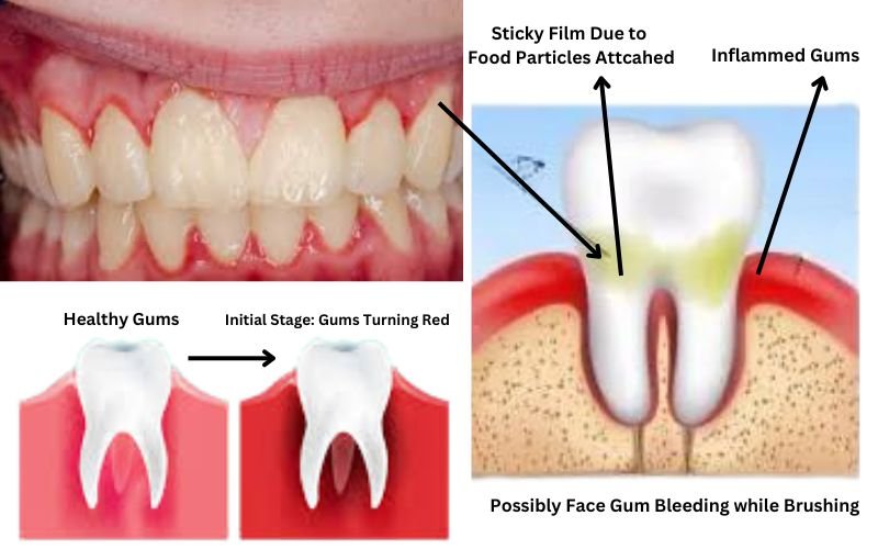 Stage-1-of-gingivitis