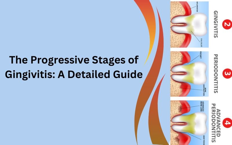Stages-of-gingivitis